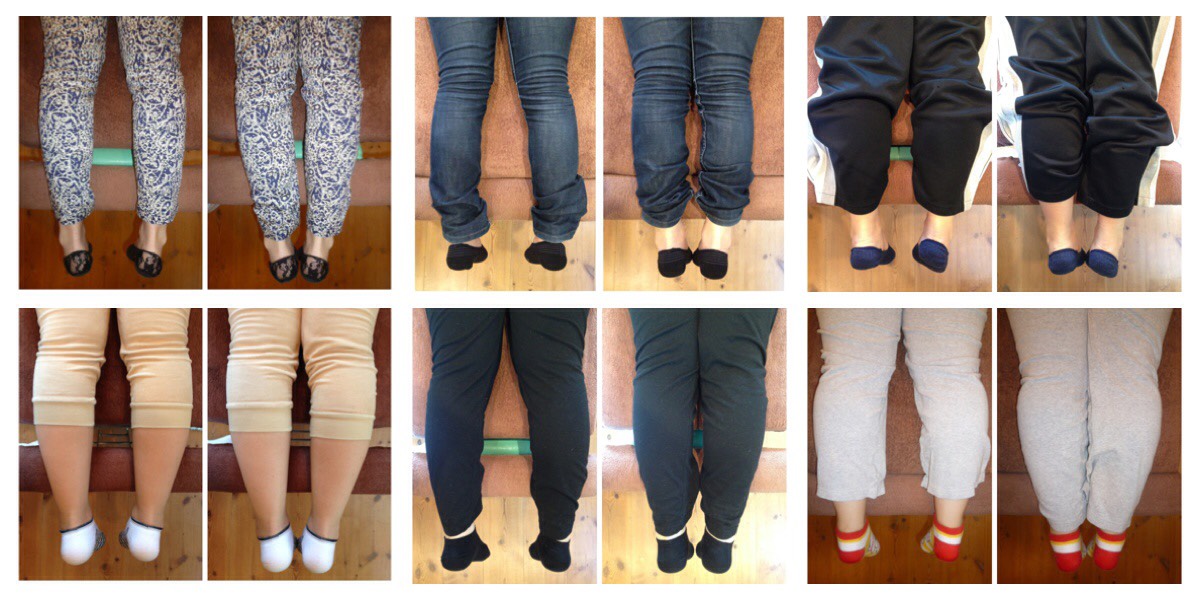 産後の骨盤矯正